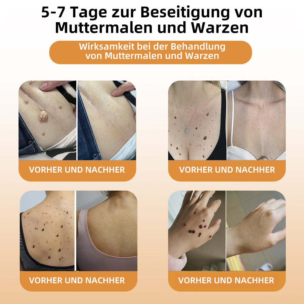 🍂🐝Brezey™ Bienengift Warze & Tag Entfernung Spray(👨‍⚕Für alle Hauttypen geeignet)🐝(🔥Aktion am letzten Tag 70% Rabatt)