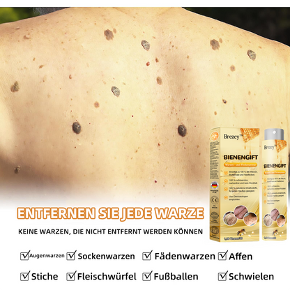 🍂🐝Brezey™ Bienengift Warze & Tag Entfernung Spray(👨‍⚕Für alle Hauttypen geeignet)🐝(🔥Aktion am letzten Tag 70% Rabatt)